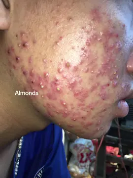 Khách dùng dịch chiết & tinh chất nọc ong Almonds , ngày mốt khách qua e xem da sẵn em quay chi tiết da hiện tại cho mụn xem ngen 