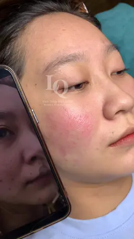 Cập nhật da sẹo #chamsocdamun#chamsocdaseo#chamsocdanam#tanbinh#Lqspa 