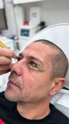 Blefaroplastia inferioară are rolul de a îndepărta depozitele de grăsime și laxitatea cutanată de sub ochi, redând zonei un contur ferm și armonios. Rezultatul: o privire rejuvenată, fără semne de oboseală. #drlevymedicalcenter #plasticsurgeonsoftiktok #blefaroplastica #blefaro 