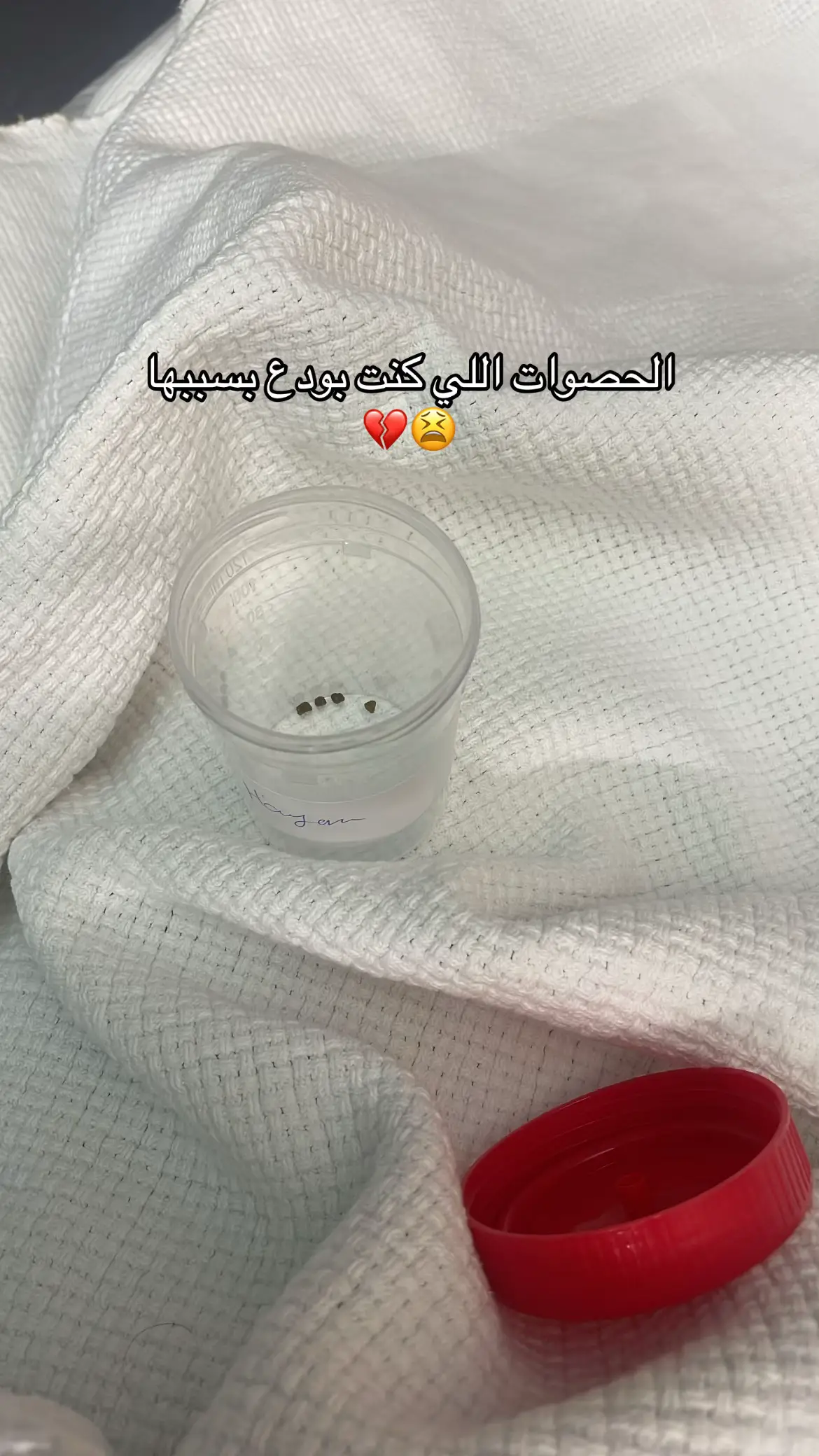 الحمدالله يارب على كل حال  #حصوات_المراره #حصوة_المراره #مستشفى_سلمان #حائل #حايلندا 