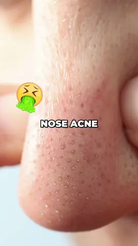 This is the quick fix to nose acne #looksmax #glowuptips #skincare #noseacne #acne 
