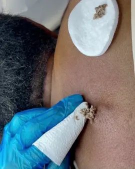 Wow🤩 #skintok #acne #acnetreatment #acneremoval #extractions            