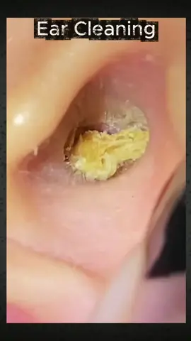 #earcleaning #ear ##earwaxcleaning #relaxing #satisfying 