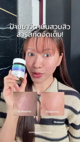 ใครเป็นสิวซ้ำๆหน้ามันๆ อยากให้ลองดู! ถูกใจคนเป็นสิวแน่นอน  #Tiktokป้ายยา #Pearletane #วิตามินสวบสิว #Nectapharma