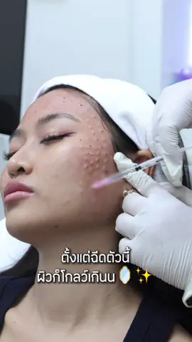ให้มันโกลว์แบบพส.เกา 🪞✨#มันดาราคลินิก #Mundalaclinic #ฉีดหน้าใส #ฉีดผิวฉ่ำ 