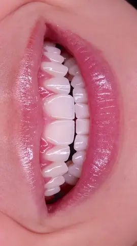 Nụ cười mới – diện mạo mới ✨ HT Smile 20 răng sứ cao cấp – nhẹ như không, đẹp chuẩn tự nhiên 😍 Cười tự tin, chuẩn phong thái riêng 💫 #HTSmile #BocSuCaoCap #NuCuoiTrieuDo#tiktokviral #xuhuong 