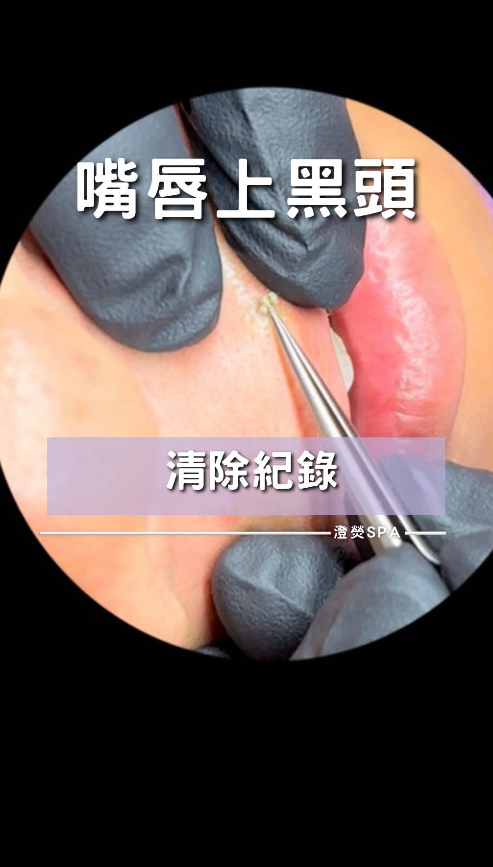 嘴唇上的黑頭清除紀錄  •┈┈┈┈┈┈୨୧ ┈┈┈┈┈┈• 📝LINE預約：@changyingspa ☎️客服電話：03-4932777 🏠店面地址：桃園市新屋區新榮路228號(近過嶺)