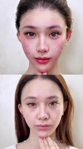 Goodbye, Smile Lines, Dark Circles & Sagging Cheeks 👋 Hello to my radiant, youthful self again! 🌸 After the 9D Lift, my face feels lighter, tighter, and full of energy — like I’ve turned back time to my brightest days. 💫 #9DFacelift #FacialLift #YouthfulFace #GlowUp #SkinTightening     