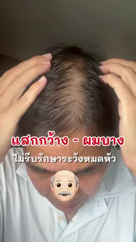 แสกกว้าง ผมบาง ไม่รีบดูแลไม่รีบรักษาระวังจะล้านหมดหัว❗️ #ผมร่วง #ผมบาง #หัวล้าน #theorientalspray #เจนนี่ได้หมดถ้าสดชื่น 
