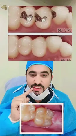 #creatorsearchinsights #teethfilling #teethwhitening #awerness #foryoupage❤️❤️ 