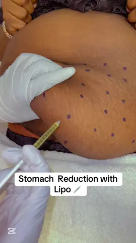 Stomach Reduction #viralllllll #ecc21oct #fypシ゚ #fatdissolving #capcutedit 