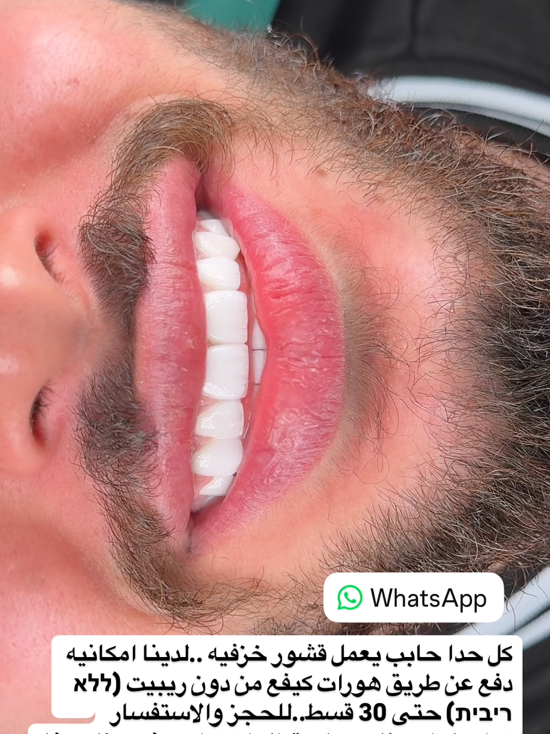 دكتور رواد أبو صالح: زراعة اسنان فورية، قشور خزفية وتجميل الأسنان بتلابيس زيركونيا #دكتور_رواد #דר_רואד #dr_rawad