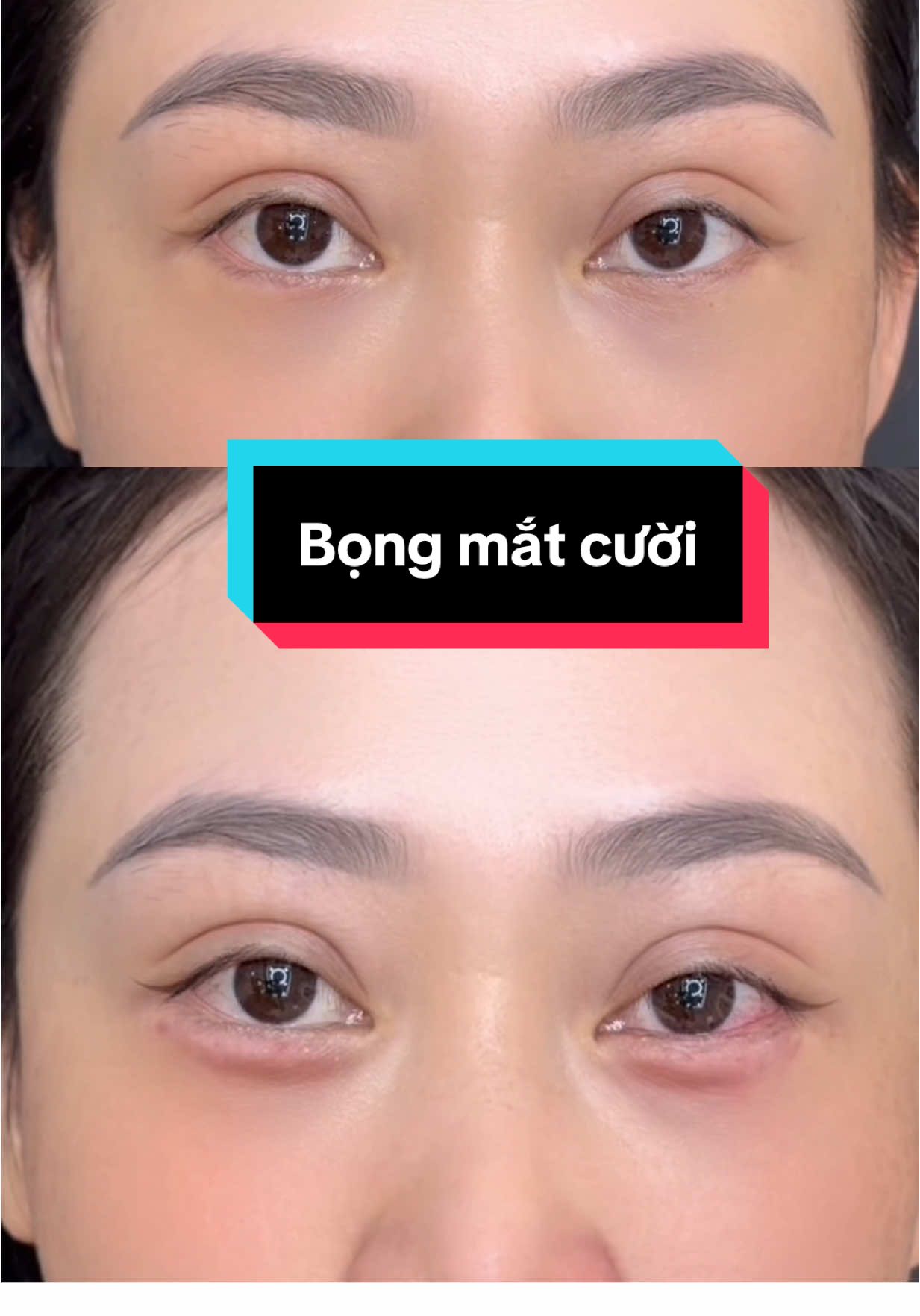 Tiêm bọng mắt giúp mắt to tròn hack mắt nhìn thu hút hơn #xuhuongthammy #xuhuong 