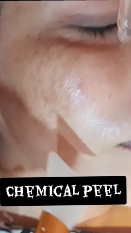 chemical peel #drmehwish #asthetic #dermatologist #gojra 