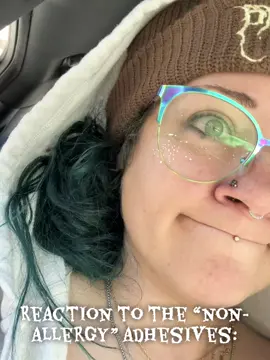 Thanks, I hate it here #potssyndrome #haltermonitor #mcas #adhesiveallergies #heds 