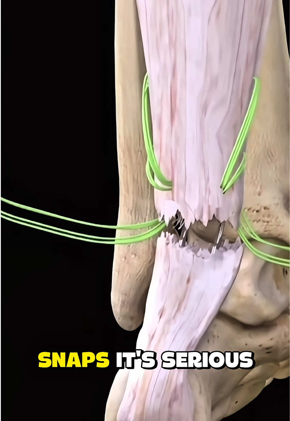 Torn Achilles Tendon Repair (3D Animation) #tornachilles #achillestendon #tendonachillesrecovery #medical3danimation #menswomenshealth 