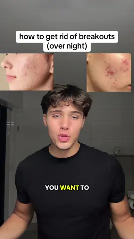 this will remove your breakouts / pimples over night  #creatorsearchinsights  #acnebreakouts #skincaretips #clearskin #pimples 