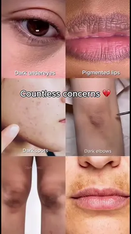 No more hyperpigmentation @KSECRET GLOBAL  #KSECRETGlowChallenge #KSECRET #seoul1988 #hyperpigmentation #darkspots				