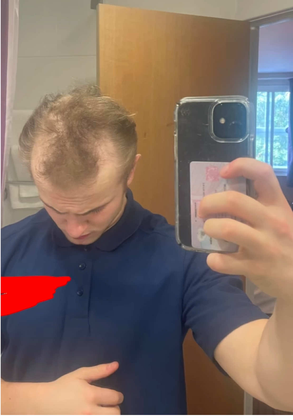 Hairloss? We’ve got you covered with #HairBear ✨ LINK IN BIO!  #hairtransplant #hairloss #hairfibers #minoxidil 