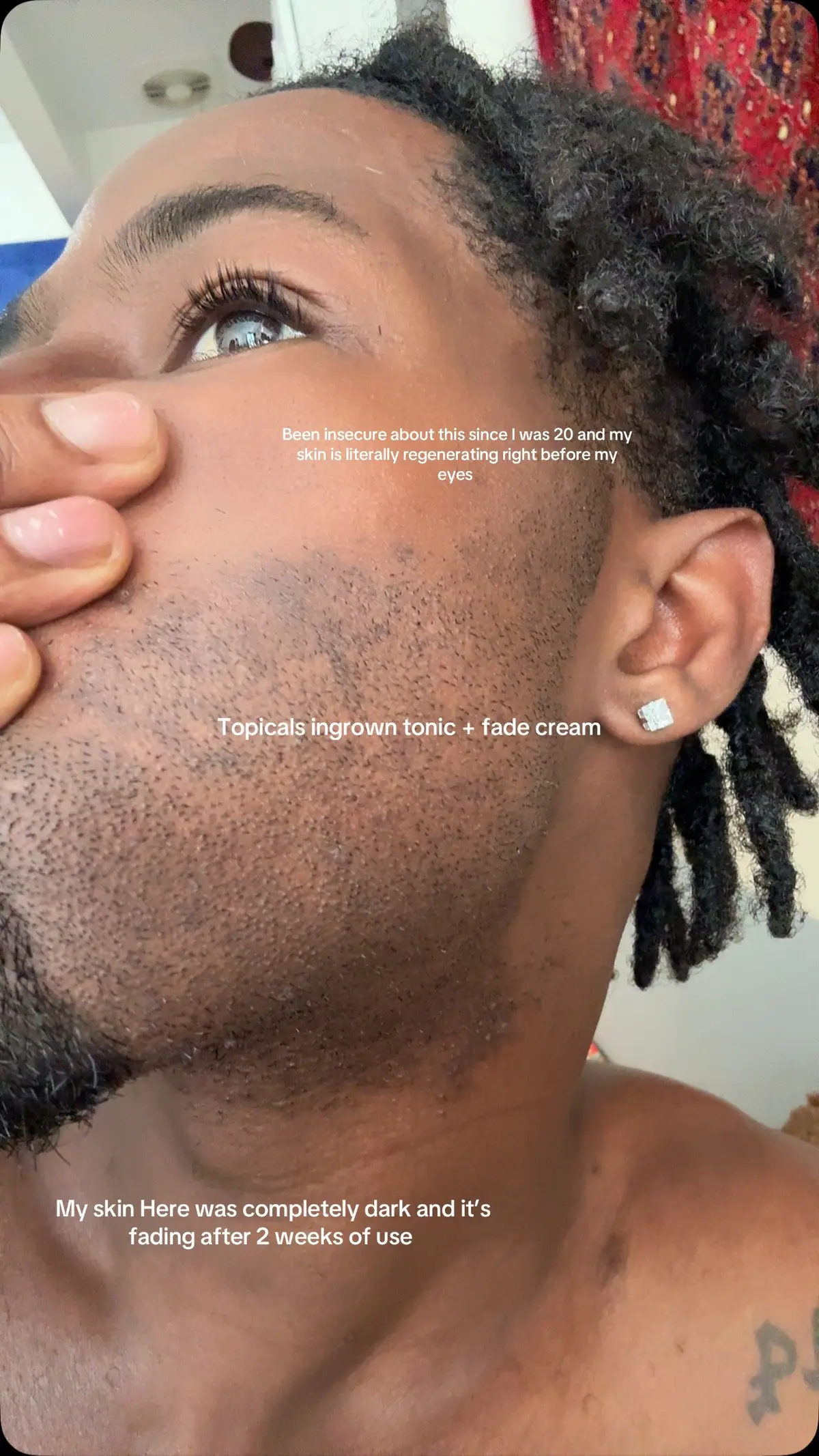 @topicals saving my life & making my skin match and getting rid of my painful and unsightly razor bumps after years of NOTHING WORKING #ugc #ugccreator #topicalsfaded #skinprogress #mensgrooming 