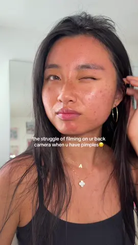 u can literally count my pores..my pimples texture are all enhanced🥲 #acne #pimples #acneproneskin #acnejourney 