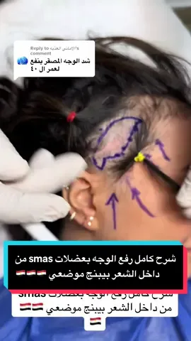 Replying to @الاماني العذبه شرح كامل رفع الوجه بعضلات smas من داخل الشعر بيبنج موضعي 🇪🇬🇪🇬🇪🇬#السعوديه🇸🇦 #د_مجدي_الفار #مصر🇪🇬 #الكويت🇰🇼 #دبي🇦🇪 