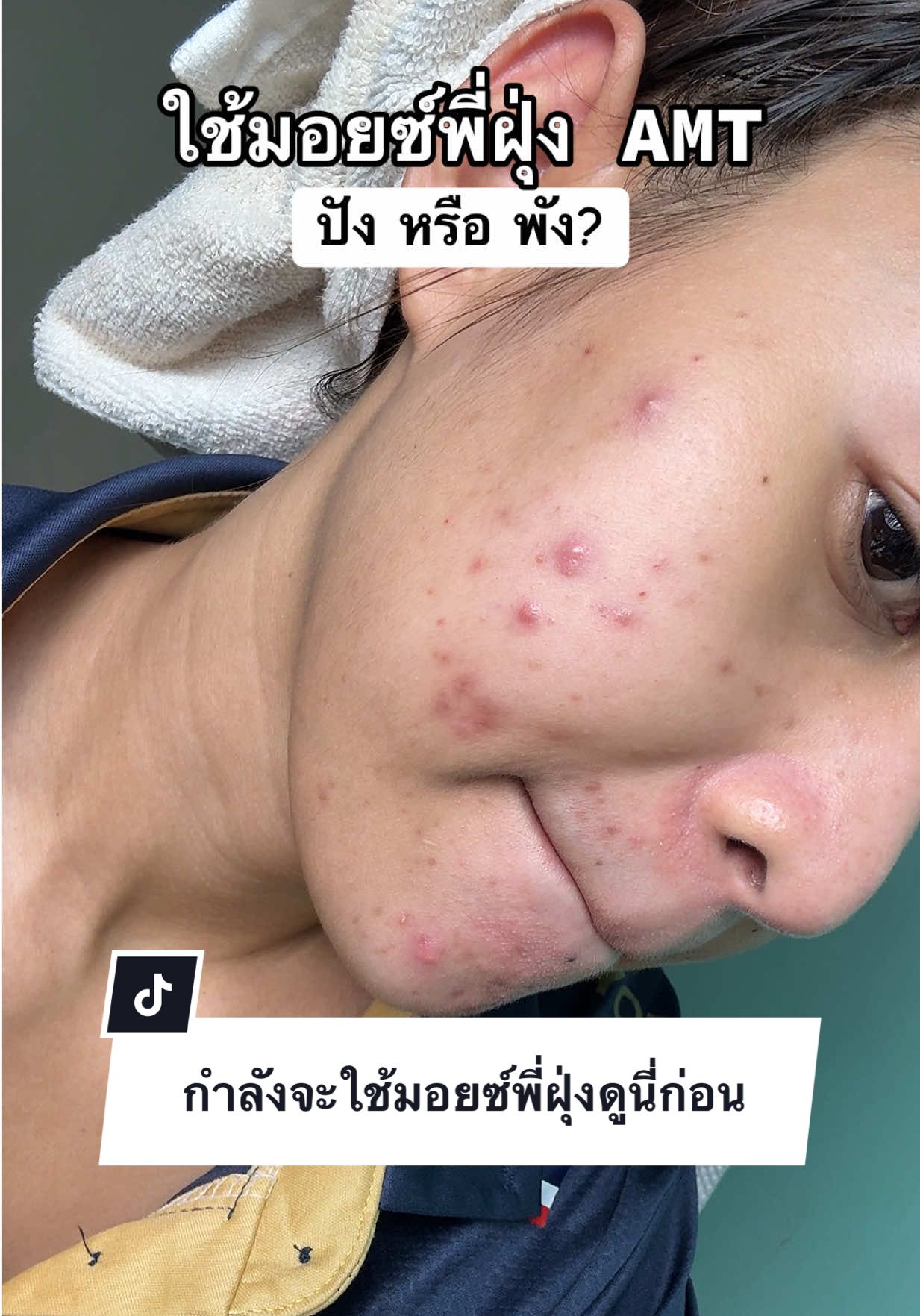 ตัดสินเอาเลยค้าบบบบบ #มอยเจอร์ไรเซอร์ #มอยซ์amt #มอยซ์พี่ฝุ่ง #สิวอักเสบ 