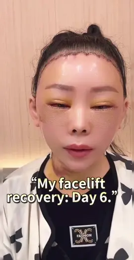 #facelift #antiaging #jawline 