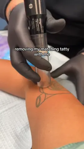 I’ve been wanting this done for so long. @RailroadCityTattoo THANK YOU!! 🙌🏻 #fyp #tattooremoval #lasertattooremoval #matchingtattoos 