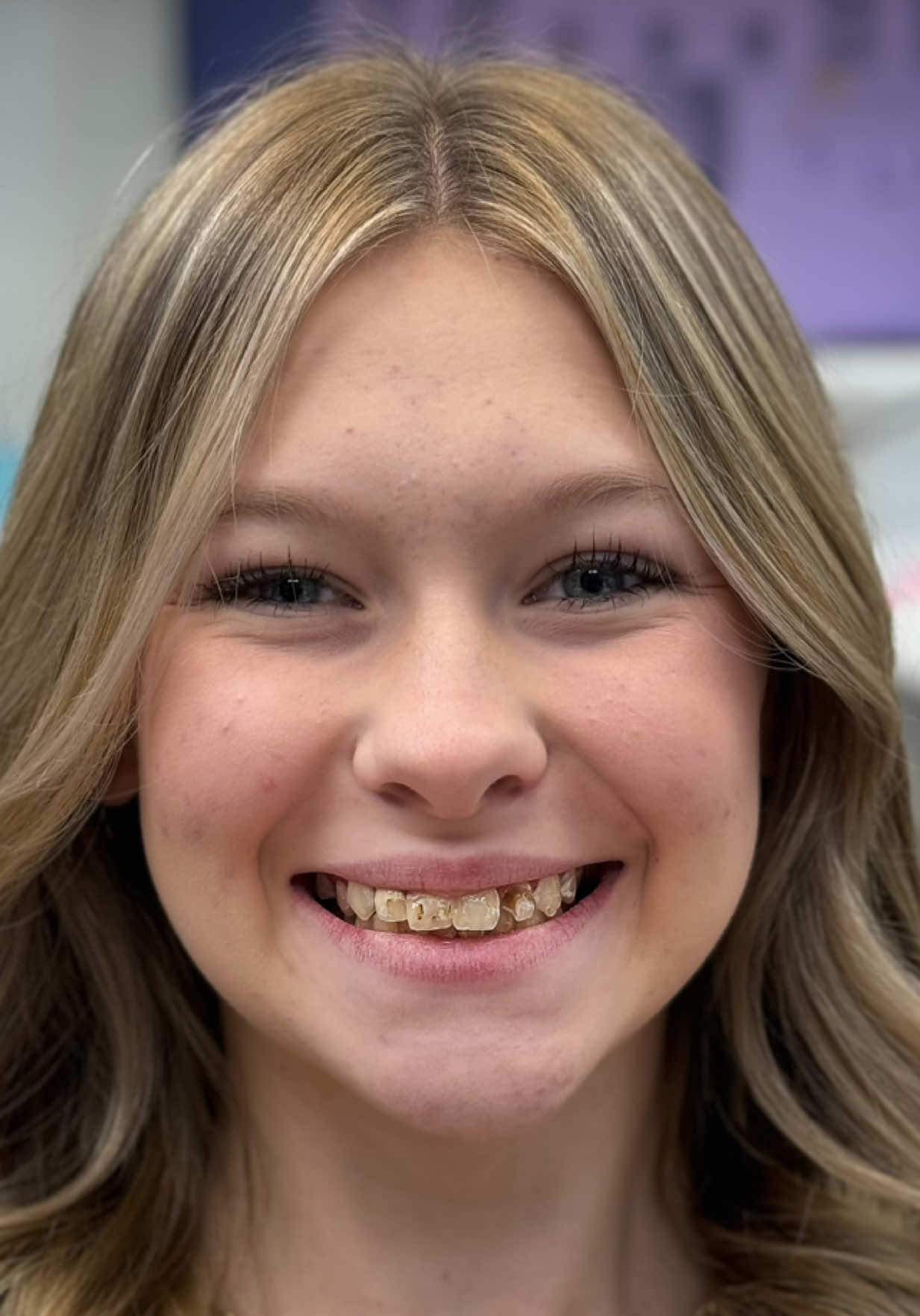 The worst way to start high school is feeling like you have to hide your smile. 14 years old, and already learning that confidence isn’t bought — it’s built. And this one was built to last. #dentistry #makeover #transformation #beauty #drkennysmiles 