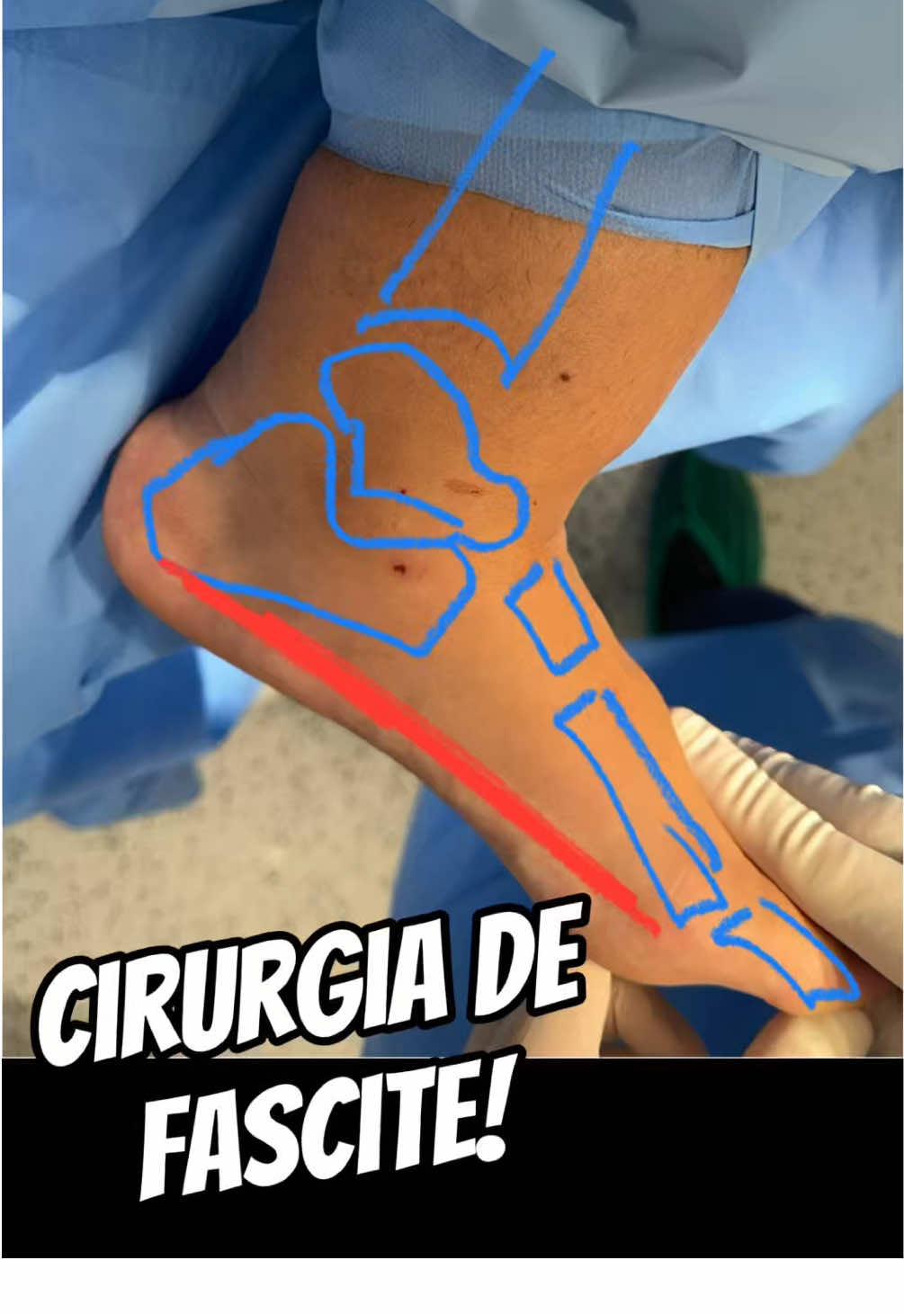 #fasciteplantar #fascite #esporao #esporaodecalcaneo 