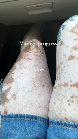 Sometimes I can’t believe how far my vitiligo spots have come on the trial! 🤍🥹  . Here are some questions I get asked a lot:  -medication: I’m in a clinical trial through Pfizer, it’s not available yet but hopefully it will@Be in the future.  -there are other trials available so I would check them out!  -I’ve been on the trial since March!  I have a playlist dedicated to my clinical trial journey 🤍 #vitiligo #vitiligoclinicaltrial #vitiligospots #vitiligomedicine #skinpositivity 