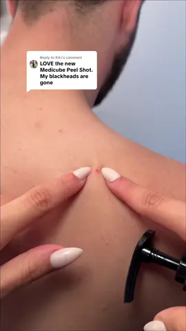Replying to @Kiki removing my husbands blackheads with the new Medicube Peel shot. This stuff works too good 😭😭😭 #peelshot #tiktokshopblackfriday #tiktokshopcreatorpicks #medicubeskincare #koreanskincare 