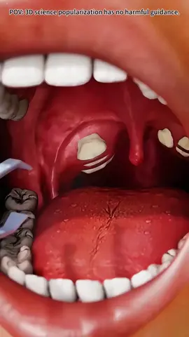How tonsil stones are form? Medical Animation 3D#tonsils #tonsillitis #tonsilstonesremoval #medicalanimation#TonsilStones #TonsilStonesExplained #TonsilStones3D #WhatAreTonsilStones #HowTonsilStonesForm #TonsilStoneFacts