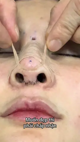 #nangmui #xuhuong #bsphamhao #suamuihong #gheptrungbi 