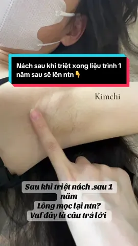 Các chị em cứ sợ sau triệt lông mọc lại cứng hơn nhiều hơn nhưng chị em ơi đối với máy triệt công nghệ xịn thì triệt xong lông tàng hình luôn ấy ạ. Đây là khách nhà kimchi sau 1 năm quay lại nè ta nói còn mấy cọng thui ạ#triệtlônglạnhbắcninh #bắcninhtriệtlônguytín #kimchibắcninh #triệtlông #triệtnách 
