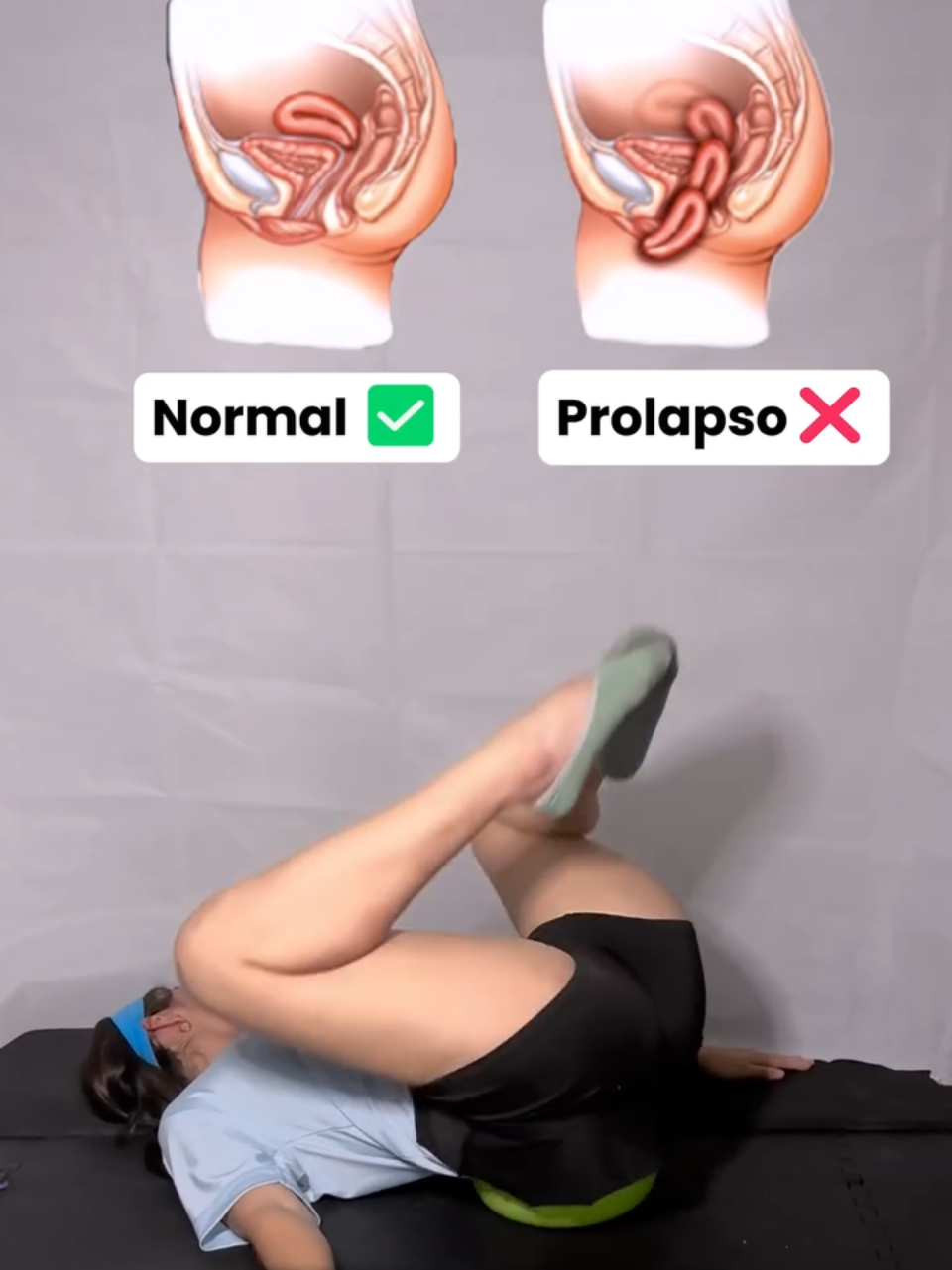 🔥 Este tema siempre es polémico, y la pregunta más interesante es: ¿qué papel juega el ENTRENAMIENTO en un diagnóstico como el prolapso de órganos internos? El papel de estos ejercicios es ayudar a prevenir un mayor descenso de los órganos, evitar que el prolapso progrese y aliviar las molestias asociadas con este problema. #Fisioterapia #ejercicio #salud #movilidad #diastasis 