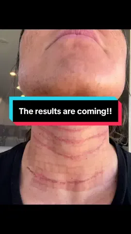 Night 3 and morning 4 I can’t believe how fast my face is Healing. The results are coming through. I’m so excited! #facecare #botox #filler #GlowUp #ageinreverse