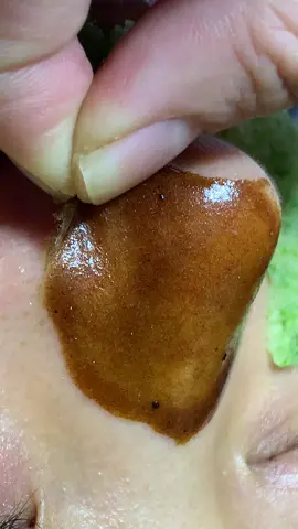 Kéo #chamsocdamun#chamsocdaseo#chamsocdanam#tanbinh#Lqspa 