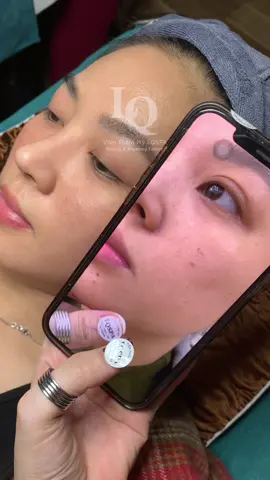 Cập nhật da sạm #chamsocdamun#chamsocdaseo#chamsocdanam#tanbinh#Lqspa 