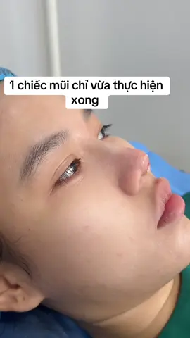 #kimbeauty #mũichỉcolagen #mũichỉ #nângmũichỉ #mũichỉđẹp 