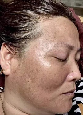 Cập Nhật da sạm #chamsocdamun#chamsocdaseo#chamsocdanam#tanbinh#Lqspa 