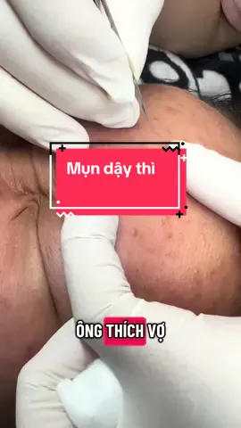 Mụn dậy thì #mun #xuhuongtiktok 