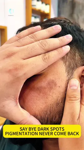 Qw Hyperpigmentation Solution...  Try aobenz serum here!#freckles #skincare #skin 