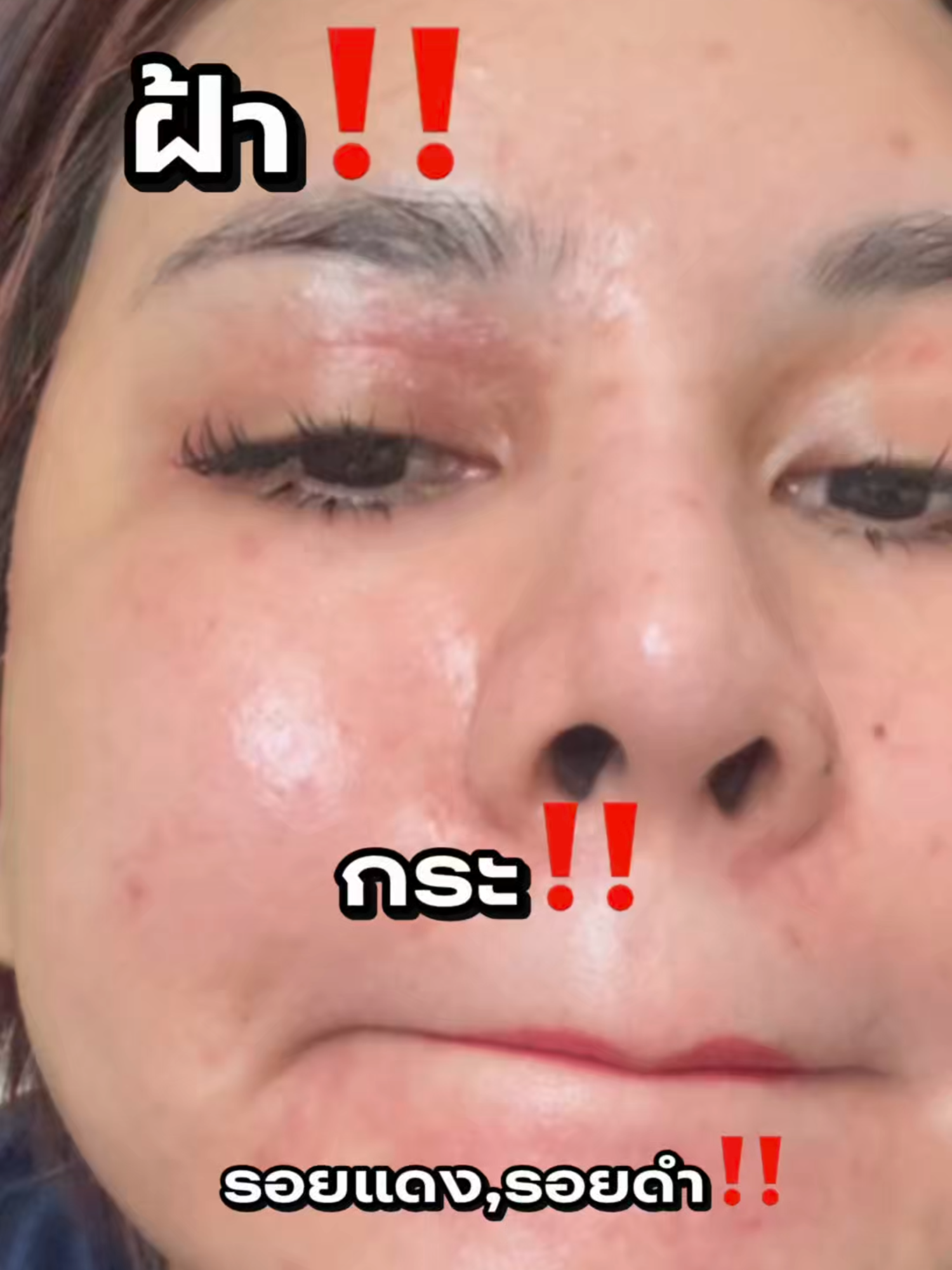 จากหน้าผัง❗ ฝ้ากระ รอยดำ เป็นผิวสว่างใสแบบนี้ ต้องเลือกครีมที่ถูก✅ #นาโนมอยส์เจอร์ไรเซอร์ครีม #lachule #สิวฝ้าริ้วรอยต้องลาชูเล่ #ฝ้า #กระ #ครีมลาชูเล่  #ครีมฝ้า #ฝ้าหนา #NanoMoisturizerCream #skincareviral