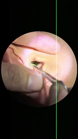 Part 19 Clean earwax for hairy customers#satisfyingasmrtingsounds #tiktokawardsusa2025 #earwax #satisfyingasmr #earwaxremoval 
