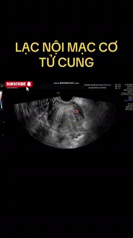 Lạc nội mạc trong cơ tử cung (Adenomyosis) Lạc nội mạc trong cơ tử cung là tình trạng mô nội mạc tử cung phát triển lạc chỗ vào lớp cơ tử cung, gây phì đại tử cung và đau bụng kinh kéo dài. Trên siêu âm, tử cung thường to, hình cầu, cấu trúc cơ không đồng nhất, có đốm tăng âm nhỏ hoặc nang nhỏ trong cơ tử cung, ranh giới nội – cơ mờ. Triệu chứng chính: đau bụng kinh dữ dội, ra máu kinh nhiều, kéo dài, đôi khi gây vô sinh. Điều trị: dùng thuốc nội tiết (progestin, GnRH agonist, thuốc tránh thai) hoặc phẫu thuật bóc nhân/ cắt tử cung khi nặng hoặc không đáp ứng điều trị nội khoa. ⸻ #lạc_nội_mạc_trong_cơ_tử_cung #adenomyosis #siêu_âm_phụ_khoa #thống_kinh #phụ_khoa_lâm_sàng 