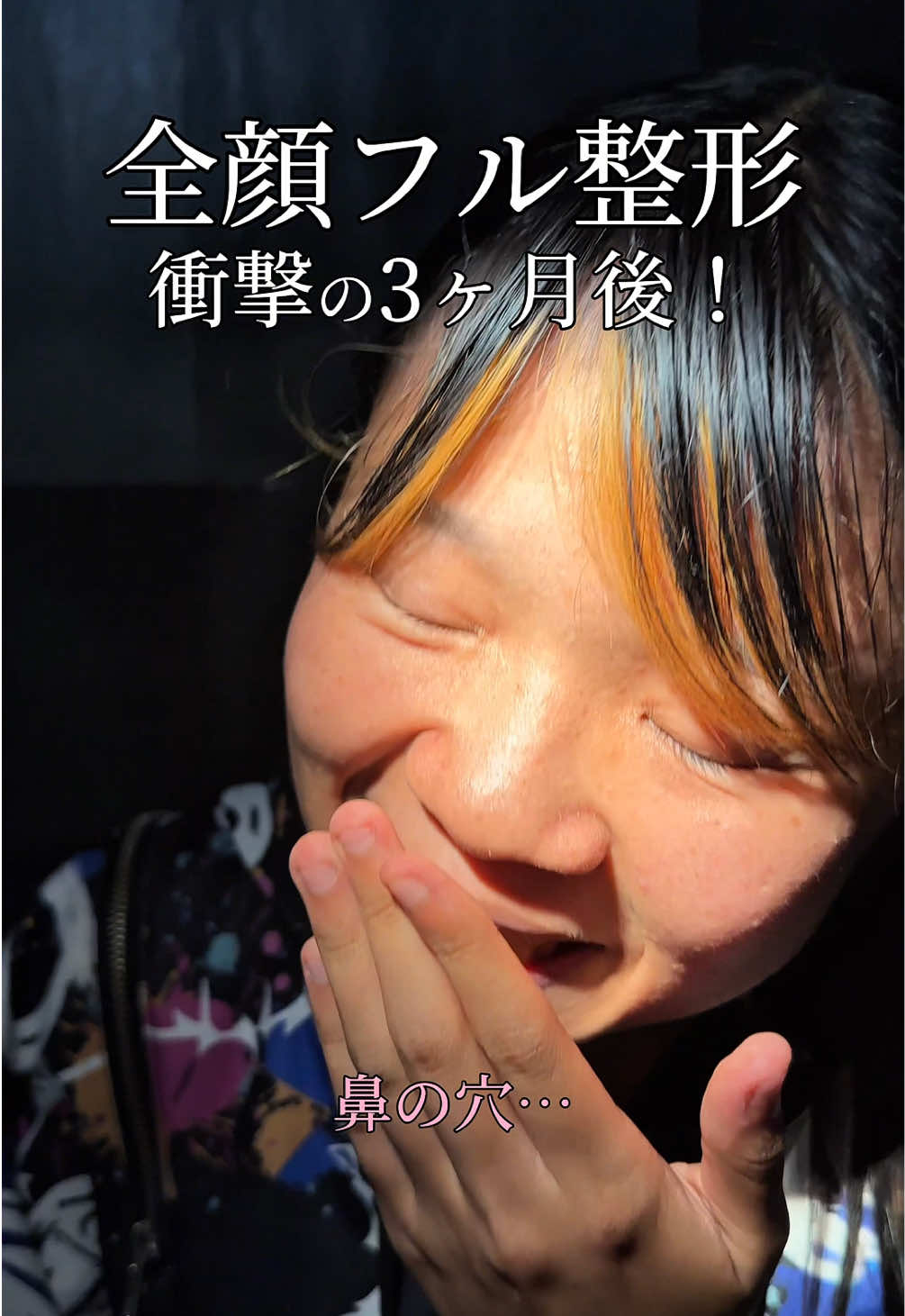 全顔フル整形 衝撃の3ヶ月後！#二重整形 #二重埋没 #TCB #東京中央美容外科 #新宿 