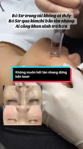 ✨ DA SÁNG MỊN – HẾT LỐM ĐỐM CHỈ SAU VÀI BUỔI ✨ Những đốm nhỏ li ti khiến làn da kém đều màu, nhìn mãi không tự tin 🥺 Chỉ sau vài buổi làm sáng da bằng công nghệ ánh sáng hiện đại tại Kim Chi Beauty, làn da đã mịn màng – tươi tắn – đều màu hơn rõ rệt 💫 💖 Liệu trình giúp: 	•	Làm mờ vùng da sạm không đều 	•	Hỗ trợ cải thiện sắc tố 	•	Cho da sáng khỏe, căng bóng tự nhiên 	•	Không bong, không nghỉ dưỡng, không sưng đỏ Khách nhà Kim Chi làm vài buổi thôi mà ai cũng khen da sáng và trẻ hơn hẳn 🌸#kimchibắcninh #dượcmypham #tàn_nhang #lasertànnhang #nám 