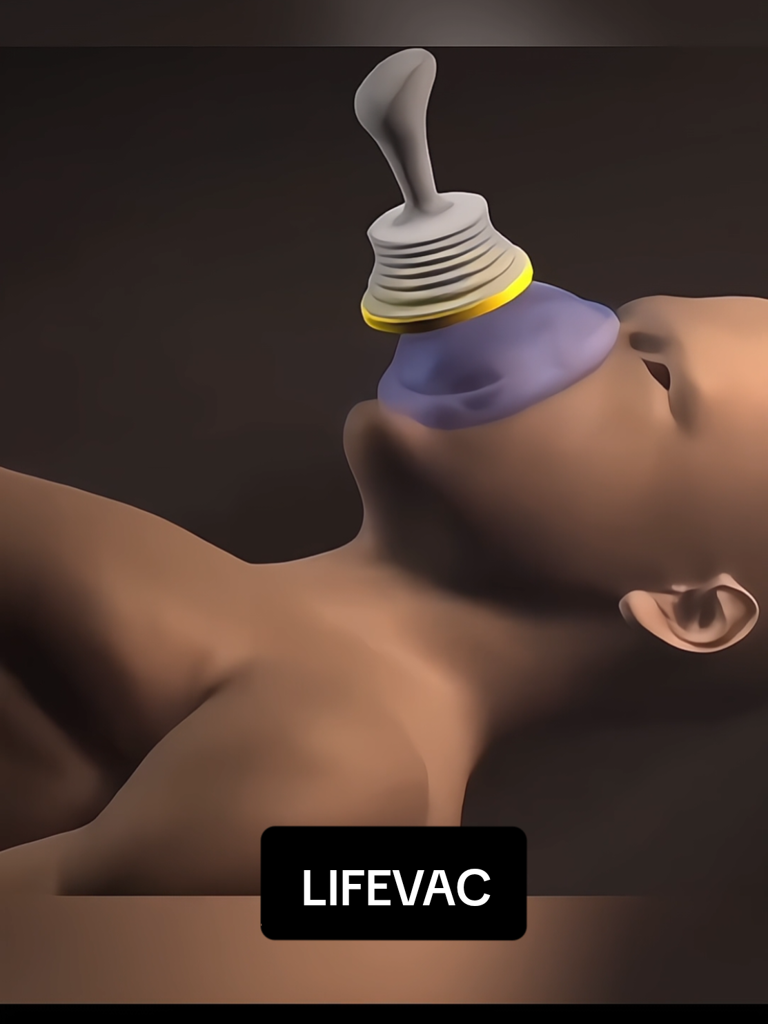 penting banget alat ini di zaman sekarang, apalagi kalo punya anak-anak. Harganya murah jangan sampai punya alesan gabisa beli! Sedia payung sebelum hujan ☺🙏🏻 #choking #chokingprevention #chokingawareness #tersedak #keselek 